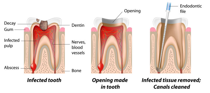 Root canal procedure steps